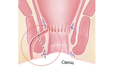 Свищ прямой кишки