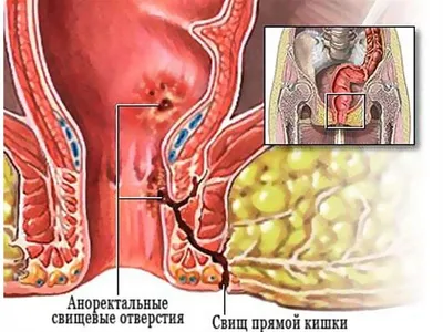 Свищ прямой кишки