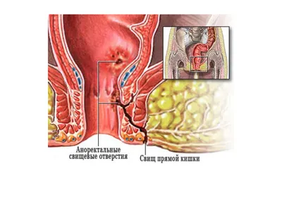 Удаление свища прямой кишки лазером и хирургически в СПб - цены, отзывы