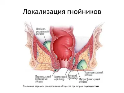 Лечение параректальных свищей любой сложности - Proctolog CLINIC