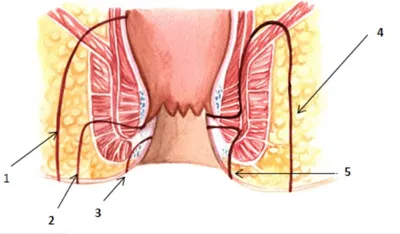 Лечение свища прямой кишки в Ивано-Франковске ⚕️ Фистулы прямой кишки