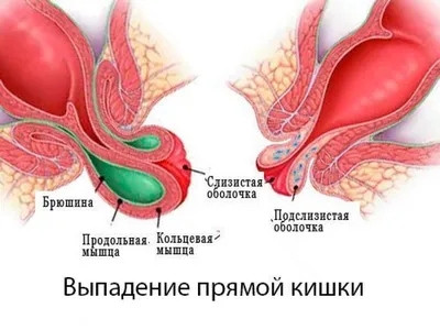 Свищи прямой кишки - лечение и удаление анальных свищей