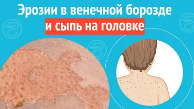 Можно ли использовать клотримазол для лечения головки члена?