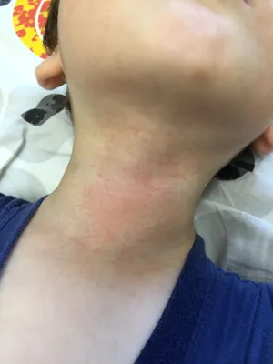 Сыпь на шее у ребенка фото