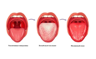 Скарлатина, особенности болезни - ангина и другие симптомы | Мир мам: блог  педиатра | Дзен
