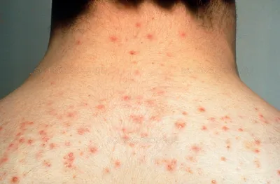 Сыпь при гепатите: фото пятен и причины их появления