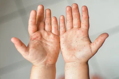 Skin manifestations of a new coronovirus infection COVID-19 caused by  SARS-CoV-2 - Khryanin - Vestnik dermatologii i venerologii