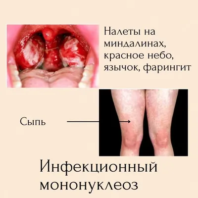 Терапия бактериальных осложнений при инфекционном мононуклеозе у детей в  амбулаторных условиях – тема научной статьи по клинической медицине читайте  бесплатно текст научно-исследовательской работы в электронной библиотеке  КиберЛенинка