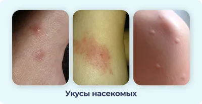 Опоясывающий лишай (опоясывающий герпес, herpes zoster): симптомы и  профилактика