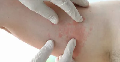Лимфома кожи: диагностика и лечение в МЦ Лазерсвiт