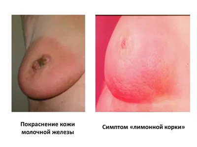 Инфекционная эритема (Erythema infectiosum)