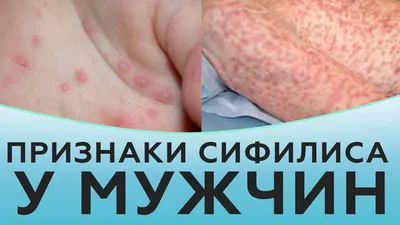 Актуальные вопросы дифференциальной диагностики крапивницы uMEDp