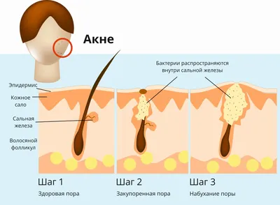 Буллезные дерматозы