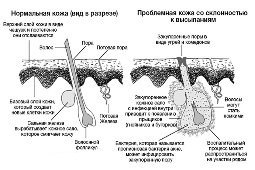 Образование угря. Акне кожа схема сальные железы. Альвеолярное строение сальной железы. Гиперплазия сальной железы дерматоскопия.