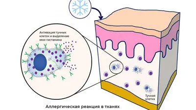 Лечение угревой сыпи и акне в Нижнем Новгороде | Клиника «Ника Спринг»