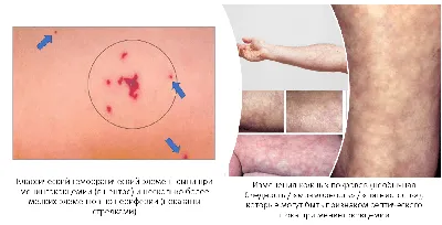 ВИЧ-инфекция - ГБУЗ СО «Новокуйбышевская центральная городская больница»