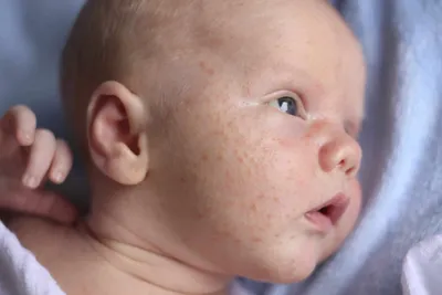 Сыпь у новорожденного на лице и голове фото