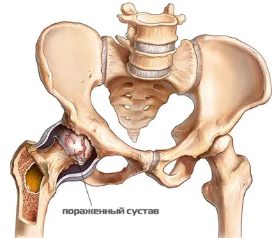Лечение болей в тазобедренных суставах в клинике Артус в Казани