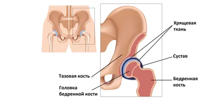 Откуда берётся боль в тазобедренном суставе и что с ней делать - Лайфхакер