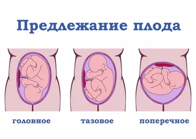 Тазовое предлежание: чем опасно и что можно предпринять?