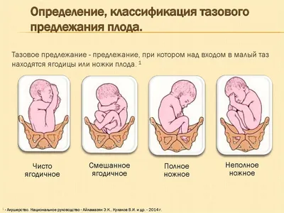 Что нужно знать о тазовом предлежании? / Почему тазовое предлежание плода  считается опасным? - YouTube