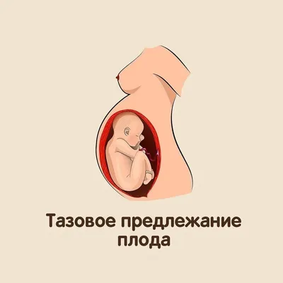 Здравствуйте уважаемые подписчики!⠀ ⠀ 🧩Тазовое предлежание плода.⠀ ⠀  Диагноз ставится в 3-5% случаях по данным УЗИ, не ранее 32 недель… |  Instagram