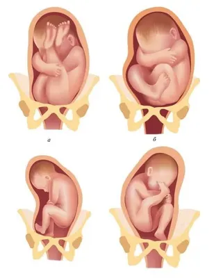 Не вдоль, а поперек: что такое поперечное положение плода и можно ли его  исправить