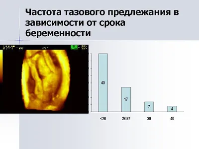 Клинические рекомендации Тазовое предлежание плода (утв. Минздравом России)