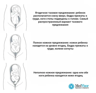 Должен ли стать общепринятой практикой профилактический поворот при тазовом  предлежании плода? – тема научной статьи по клинической медицине читайте  бесплатно текст научно-исследовательской работы в электронной библиотеке  КиберЛенинка