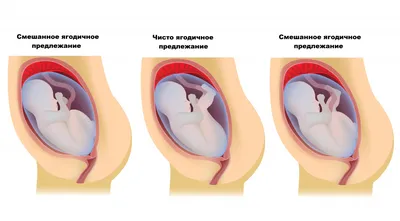 Тазовое предлежание плода – что это, причины, симптомы, диагностика и  лечение в клинике «Будь Здоров»