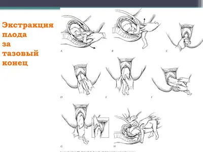 Головное предлежание плода - причины, симптомы, диагностика и лечение в  клинике «Будь Здоров»