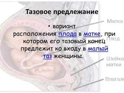 УЗИ ВРАЧ АЛИМБЕКОВ on Instagram: \"Тазовое предлежание плода – это ситуация,  когда плод головкой располагается в дне, а у малого таза матери находятся  его ягодицы и/или ножки. В норме плод расположен в