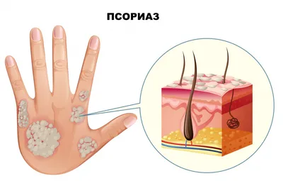 КЛИНИЧЕСКИЙ СЛУЧАЙ ЛАДОННО-ПОДОШВЕННОЙ КЕРАТОДЕРМИИ УННЫ–ТОСТА