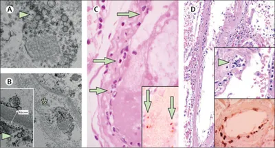 Revisiting the question of cutaneous vasculitis classification - Samtsov -  Vestnik dermatologii i venerologii