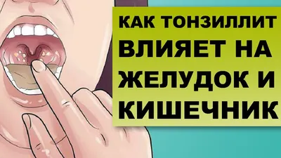 Тонзиллит - причины появления, симптомы заболевания, диагностика и способы  лечения