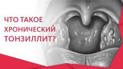 Хронический тонзиллит | Evolutis Clinic | Дзен