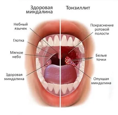 Медицинские центры КЦВ МИР - Ангина (острый тонзиллит) имеет инфекционную  природу и сопровождается появлением острого воспалительного процесса в  области небных миндалин. 👉 Развитие заболевания происходит при контакте со  стрептококком и стафилококком, а