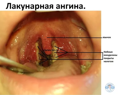 Тонзиллит опасен тяжелыми осложнениями | Ганцавіцкі час