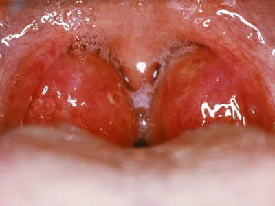 Тонзиллит у ребенка: что делать? Профилактика и лечение тонзиллита у детей