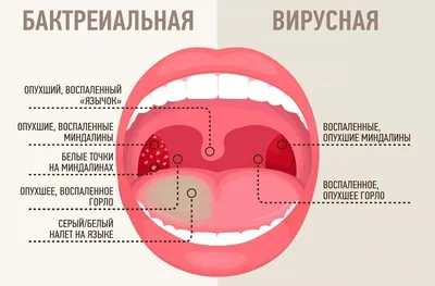 Хронический тонзиллит и ангина