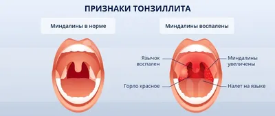 Клинические рекомендации \"Острый тонзиллит и фарингит (Острый  тонзиллофарингит)\" (утв. Министерством здравоохранения РФ, 2021 г.)