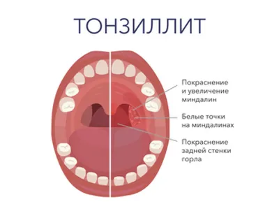 Хронический тонзиллит