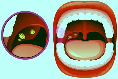 Тонзиллит - диагностика и лечение в Москве