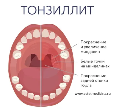 Тонзиллит: симптомы и признаки, лечение, профилактика и препараты