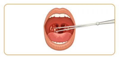 Хронический тонзиллит | Пикабу