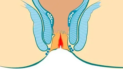 Анальные трещины: причины, симптомы и лечение
