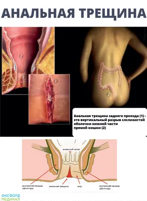 Анальные трещины и геморрой: симптомы, диагностика, отличия, что это и как  лечить