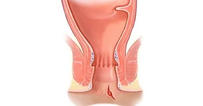 Анальная трещина, как выявить и вылечить болезнь