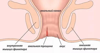 Анальные трещины заднего прохода