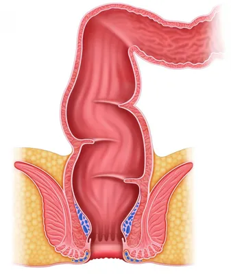 Не заживает трещина в заднем проходе, кровь, кондилома, может ли болеть —  блог ОН Клиник